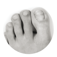 Athlete’s foot and fungal nail conditions