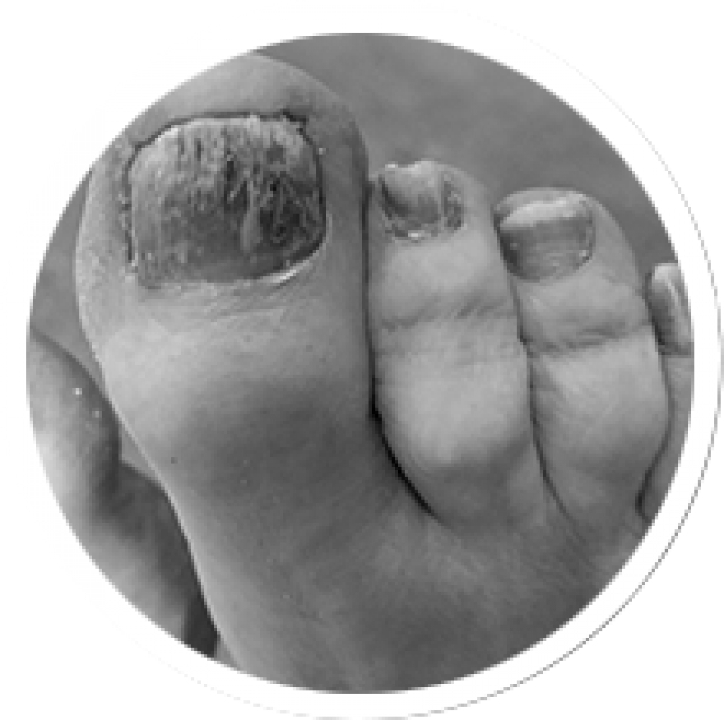 toenail conditions get treatment at the dalkey podiatry clinic
