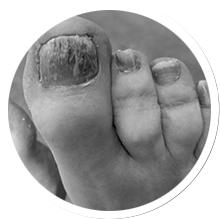 Do you have a toenail condition?
